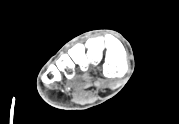 Advanced osteomyelitis due to open metatarsal fracture (Radiopaedia 83891-99095 Axial non-contrast 26).jpg