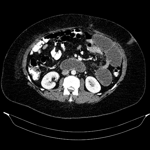 Afferent loop syndrome - secondary to incarcerated trocar site hernia (Radiopaedia 82959-97305 Axial C+ portal venous phase 109).jpg