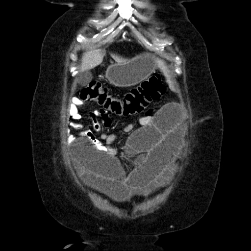 File:Afferent loop syndrome - secondary to incarcerated trocar site hernia (Radiopaedia 82959-97305 Coronal C+ portal venous phase 41).jpg