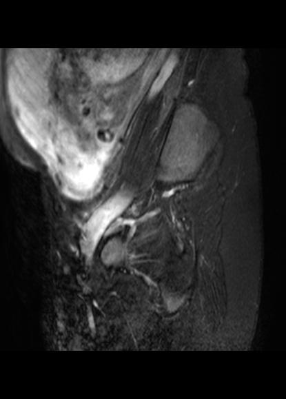 File:Aggressive angiomyxoma of the pelvis and perineum (Radiopaedia 59162-66479 Sagittal T2 fat sat 1).jpg