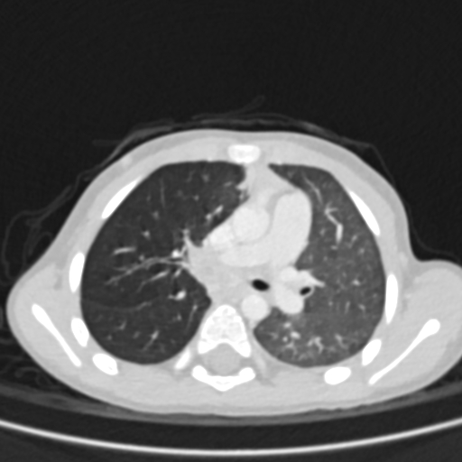 Airway foreign body (Radiopaedia 72128-82638 Axial lung window 36).jpg