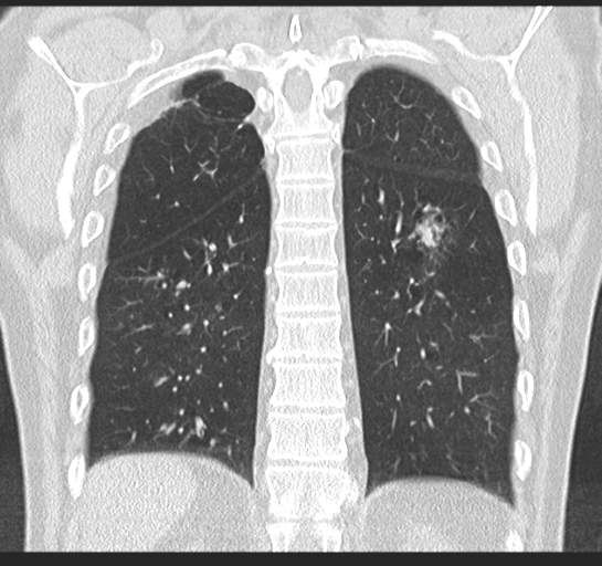 Allergic bronchopulmonary aspergillosis (Radiopaedia 44760-48571 Coronal lung window 45).png