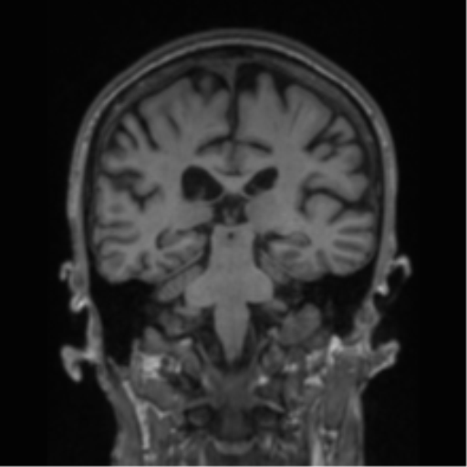 File:Alzheimer's disease- with apraxia (Radiopaedia 54763-61011 Coronal T1 42).png