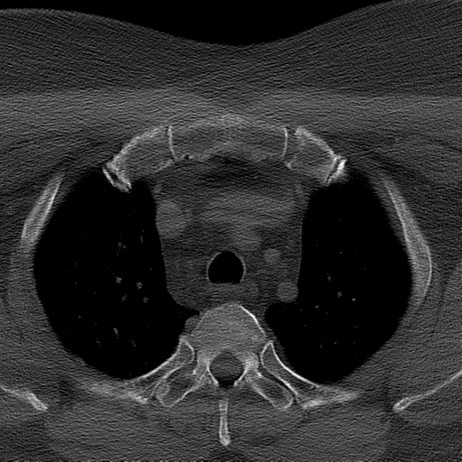 Ameloblastoma (Radiopaedia 38520-40623 Axial bone window 83).png