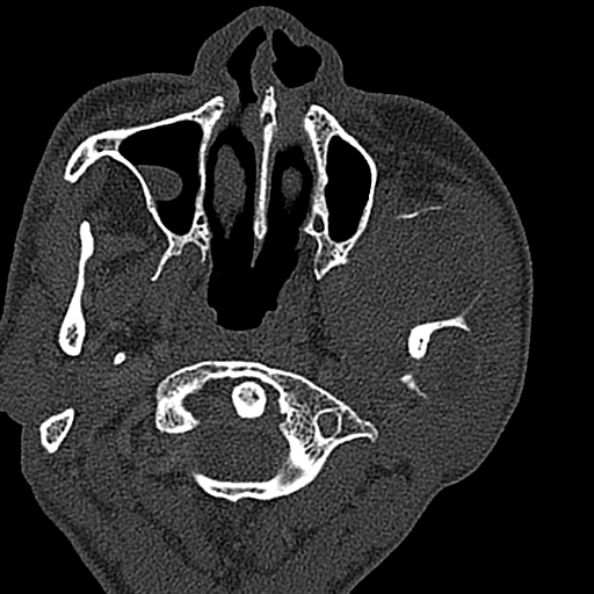 Ameloblastoma (Radiopaedia 51921-57766 Axial bone window 114).jpg
