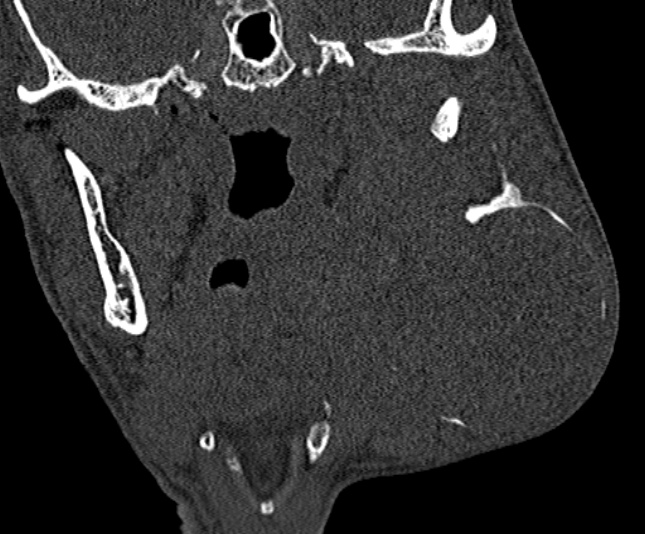 Ameloblastoma (Radiopaedia 51921-57766 Coronal bone window 158).jpg