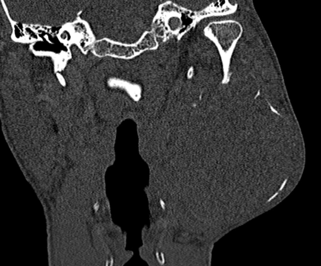 Ameloblastoma (Radiopaedia 51921-57766 Coronal bone window 189).jpg