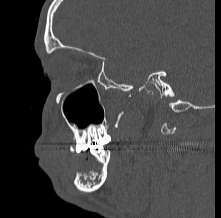 Ameloblastoma (Radiopaedia 77750-89997 Sagittal bone window 48).jpg