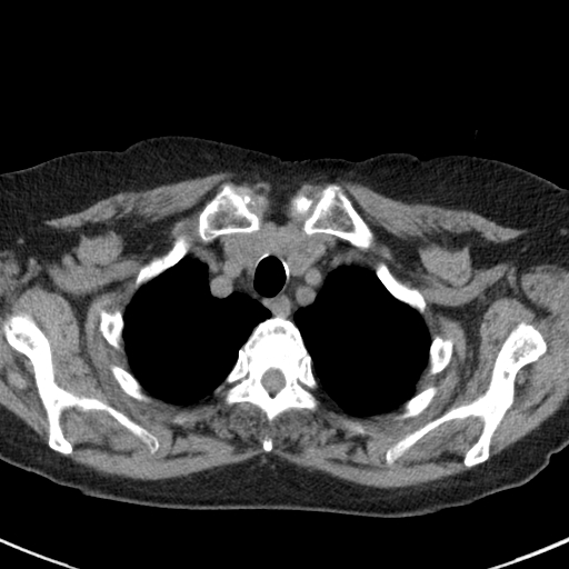 File:Amiodarone-induced pulmonary fibrosis (Radiopaedia 82355-96460 Axial non-contrast 12).jpg