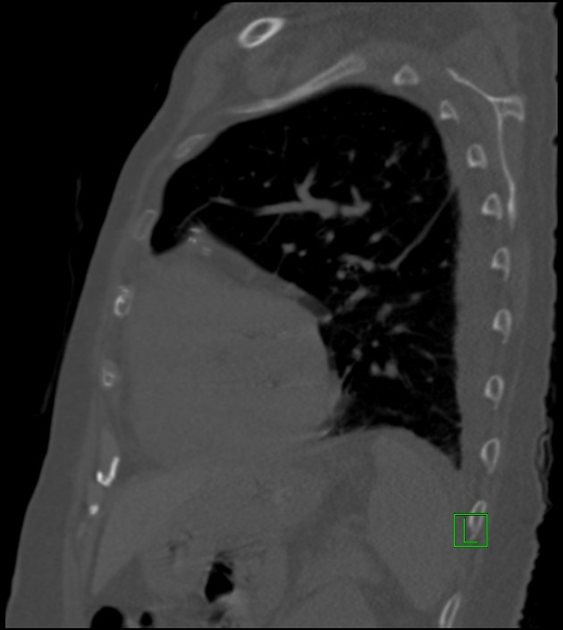 Amiodarone deposition in the liver (Radiopaedia 77587-89780 Sagittal bone window 31).jpg