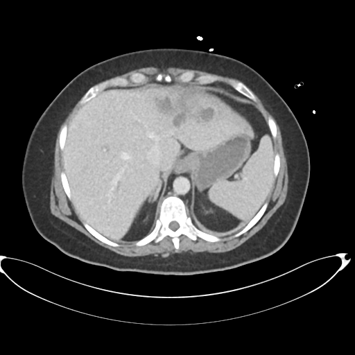 File:Amoebic liver abscess (Radiopaedia 52611-58530 A 18).png