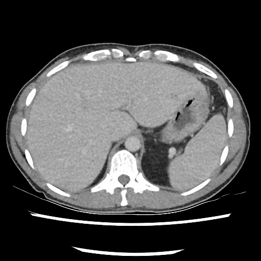 Amoebic liver abscesses (Radiopaedia 55536-62010 A 21).jpg