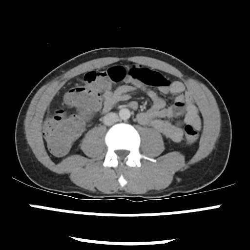 Amoebic liver abscesses (Radiopaedia 55536-62010 A 52).jpg