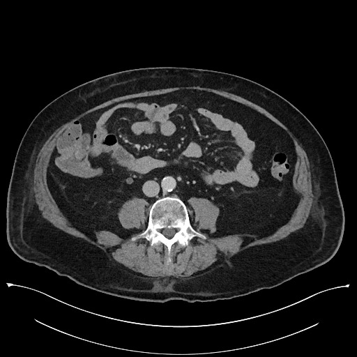 Ampullary adenocarcinoma (Radiopaedia 59373-66737 A 98).jpg