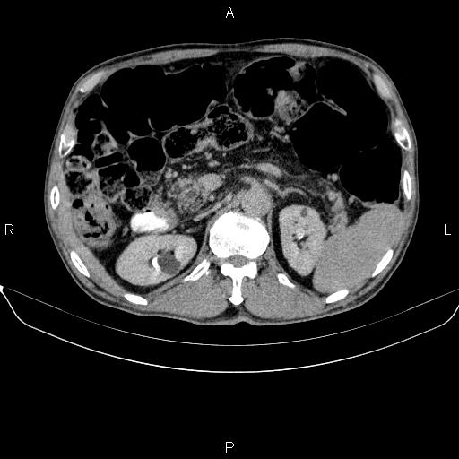 Ampullary adenocarcinoma (Radiopaedia 86093-102032 Axial C+ delayed 34).jpg