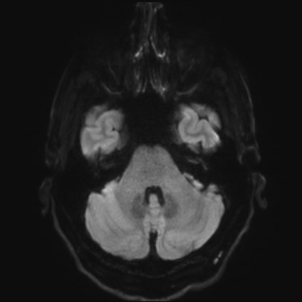 Amyotrophic lateral sclerosis (Radiopaedia 87352-103658 Axial DWI 34).jpg