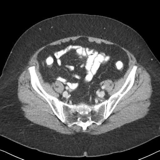 Anal adenocarcinoma - tumor regression grade 1 (Radiopaedia 31358-32103 Axial POST 57).jpg