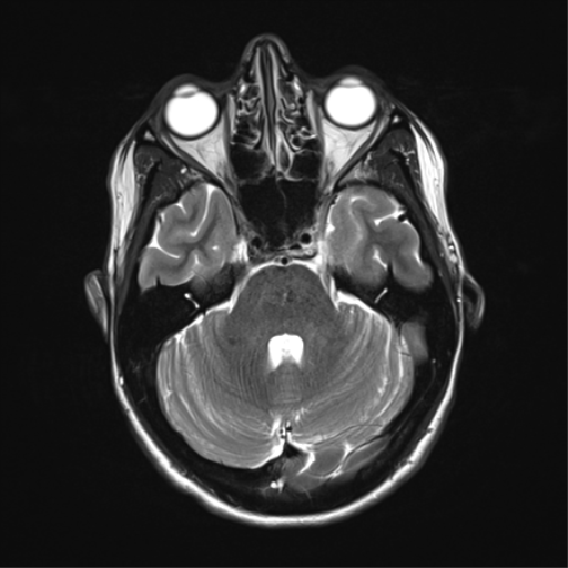 File:Anaplastic astrocytoma IDH mutant (Radiopaedia 50046-55341 Axial T2 12).png