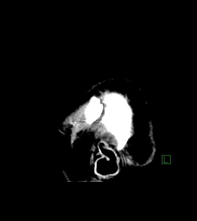 Anaplastic oligodendroglioma (Radiopaedia 79571-92758 C 5).jpg