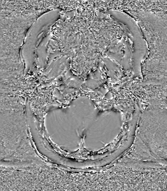 Anaplastic oligodendroglioma (Radiopaedia 83500-98599 Axial SWI - phase 9).png