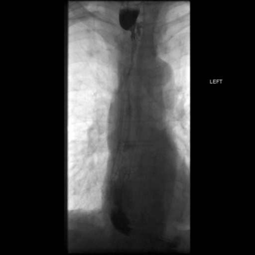 File:Anastomotic stricture post Ivor Lewis esophagectomy (Radiopaedia 47937-52715 B 34).png