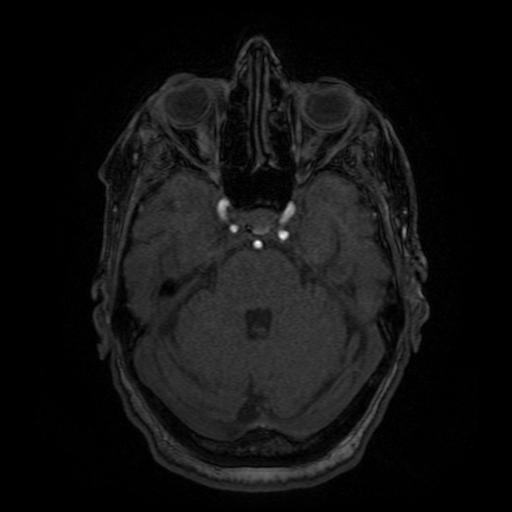 Aneurysm of the terminal internal carotid artery (Radiopaedia 88167-104764 H 45).jpg