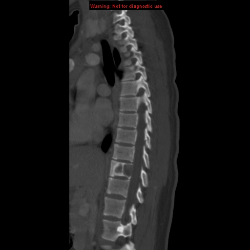 File:Aneurysmal bone cyst (Radiopaedia 9419-10102 Sagittal bone window 5).jpg