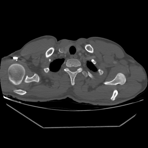 Aneurysmal bone cyst - rib (Radiopaedia 82167-96220 Axial bone window 43).jpg