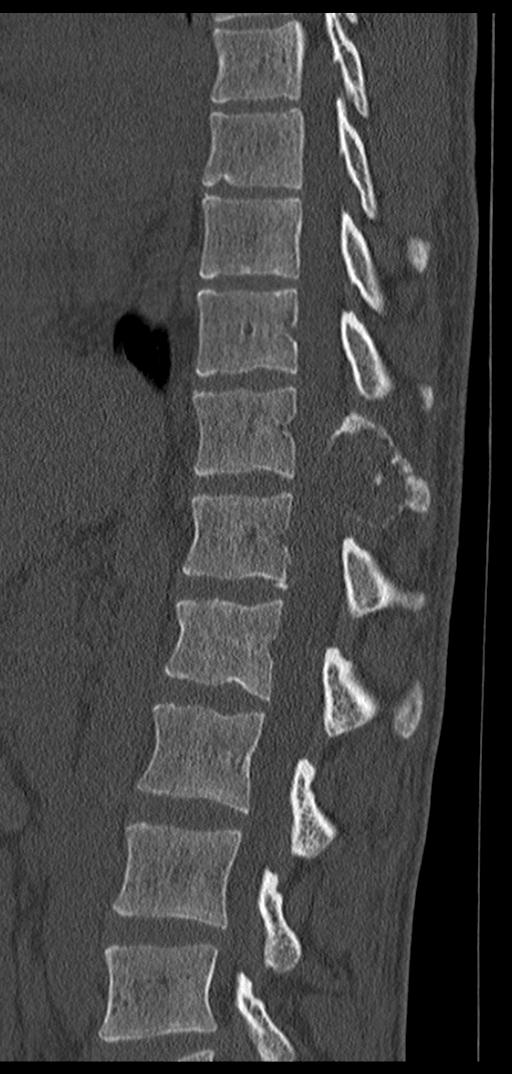Aneurysmal bone cyst T11 (Radiopaedia 29294-29721 Sagittal bone window 37).jpg