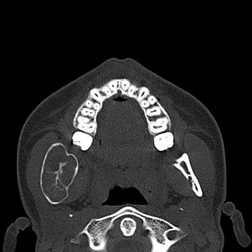 File:Aneurysmal bone cyst of the mandible (Radiopaedia 43280-46601 Axial bone window 45).jpg