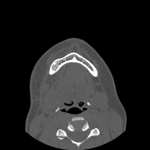 Aneurysmal bone cyst of the mandible (Radiopaedia 43280-46823 Axial bone window 20).jpg