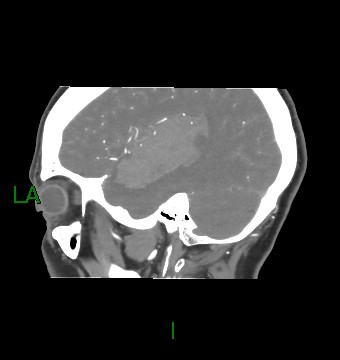 Aneurysmal subarachnoid hemorrhage with intra-axial extension (Radiopaedia 84371-99732 B 53).jpg