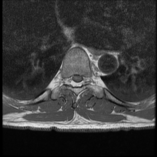 File:Angiolipoma - thoracic spine (Radiopaedia 28242-28479 Axial T1 6).jpg