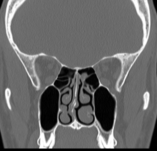 Angular epidermoid cyst (Radiopaedia 46908-51439 Coronal bone window 34).png