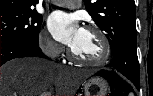 Anomalous left coronary artery from the pulmonary artery (ALCAPA) (Radiopaedia 70148-80181 B 161).jpg