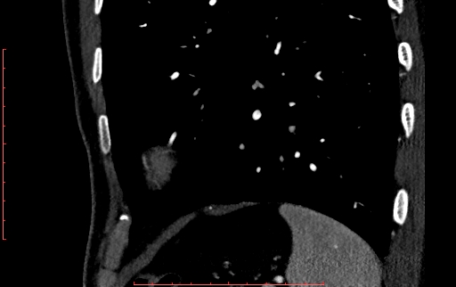 Anomalous left coronary artery from the pulmonary artery (ALCAPA) (Radiopaedia 70148-80181 C 265).jpg