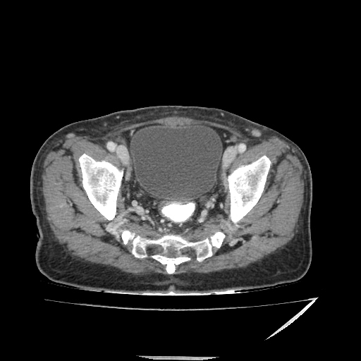 Anorectal carcinoma (Radiopaedia 44413-48064 A 47).jpg
