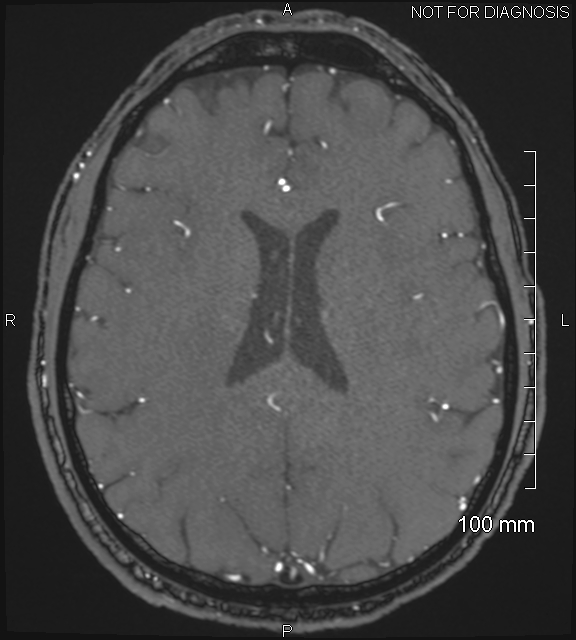 Anterior cerebral artery aneurysm (Radiopaedia 80683-94127 Axial MRA 156).jpg
