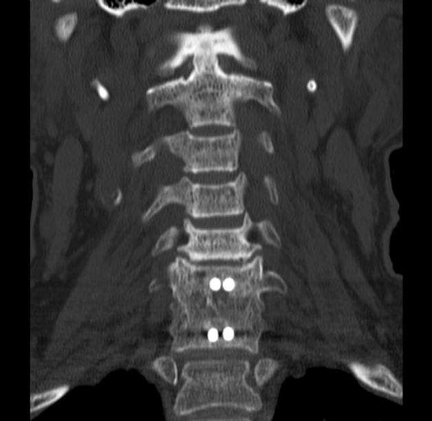 Anterior cervical postdiscectomy arthrodesis (Radiopaedia 32678-33646 Coronal bone window 20).jpg