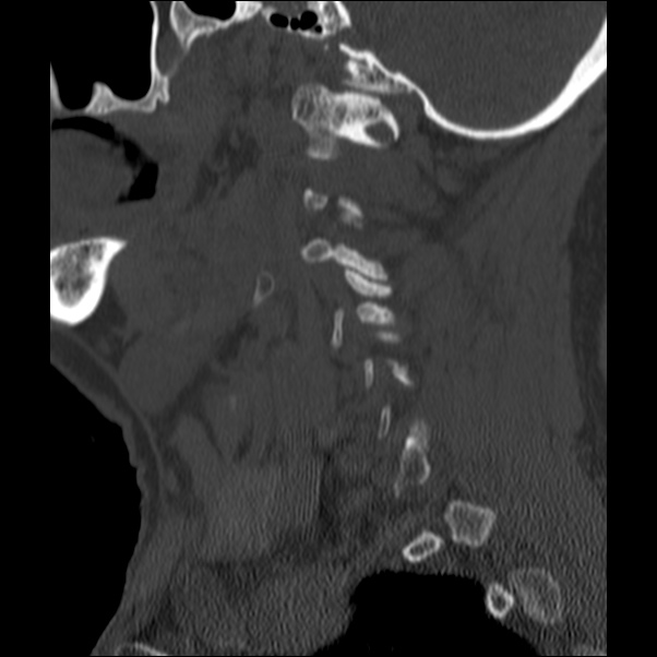 Anterior cervical postdiscectomy arthrodesis (Radiopaedia 32678-33646 Sagittal bone window 14).jpg