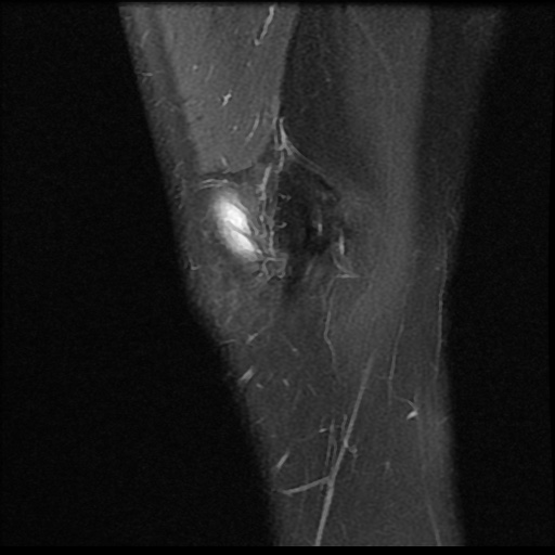 File:Anterior cruciate ligament avulsion fracture (Radiopaedia 58939-66193 Sagittal PD fat sat 20).jpg