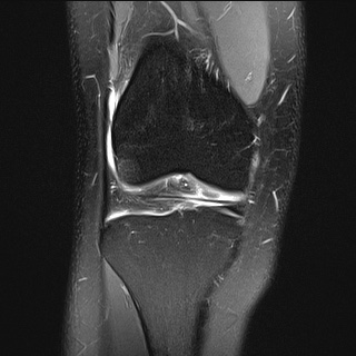 File:Anterior cruciate ligament rupture and posteromedial corner injury (Radiopaedia 67338-76723 Coronal PD fat sat 18).jpg