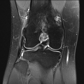 File:Anterior cruciate ligament rupture and posteromedial corner injury (Radiopaedia 67338-76723 Coronal PD fat sat 9).jpg