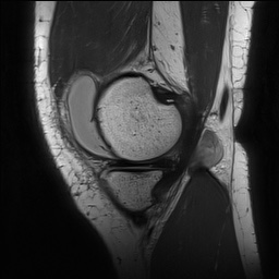 Anterior cruciate ligament rupture with Segond fracture (Radiopaedia 69043-78806 Sagittal PD 45).jpg