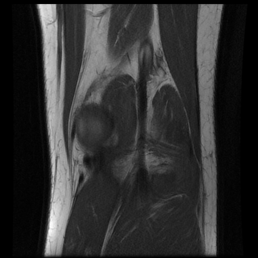 File:Anterior cruciate ligament tear (Radiopaedia 61500-69462 Coronal T1 18).jpg