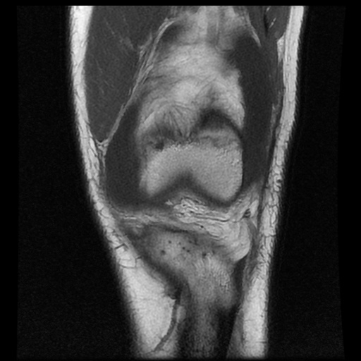 File:Anterior cruciate ligament tear (Radiopaedia 61500-69462 Coronal T1 6).jpg