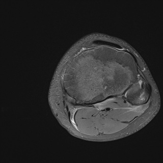 File:Anterior cruciate ligament tear - pediatric (Radiopaedia 62152-70260 Axial PD fat sat 31).jpg