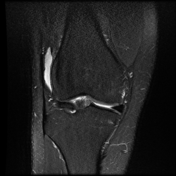 File:Anterior cruciate ligament tear with posteromedial corner injury, bucket-handle meniscal tear and chondral delamination (Radiopaedia 75501-86744 Coronal PD fat sat 10).jpg