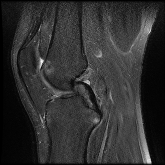File:Anterior cruciate ligament tear with posteromedial corner injury, bucket-handle meniscal tear and chondral delamination (Radiopaedia 75501-86744 Sagittal PD fat sat 13).jpg