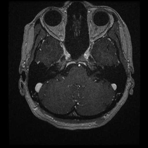 Anterior inferior cerebellar artery vascular loop - type II (Radiopaedia 70991-81209 Axial T1 C+ 53).jpg